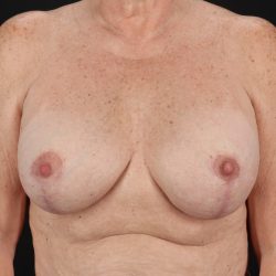 Implant Revision Before & After Patient #3221