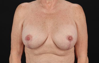 Implant Revision Before & After Patient #3221