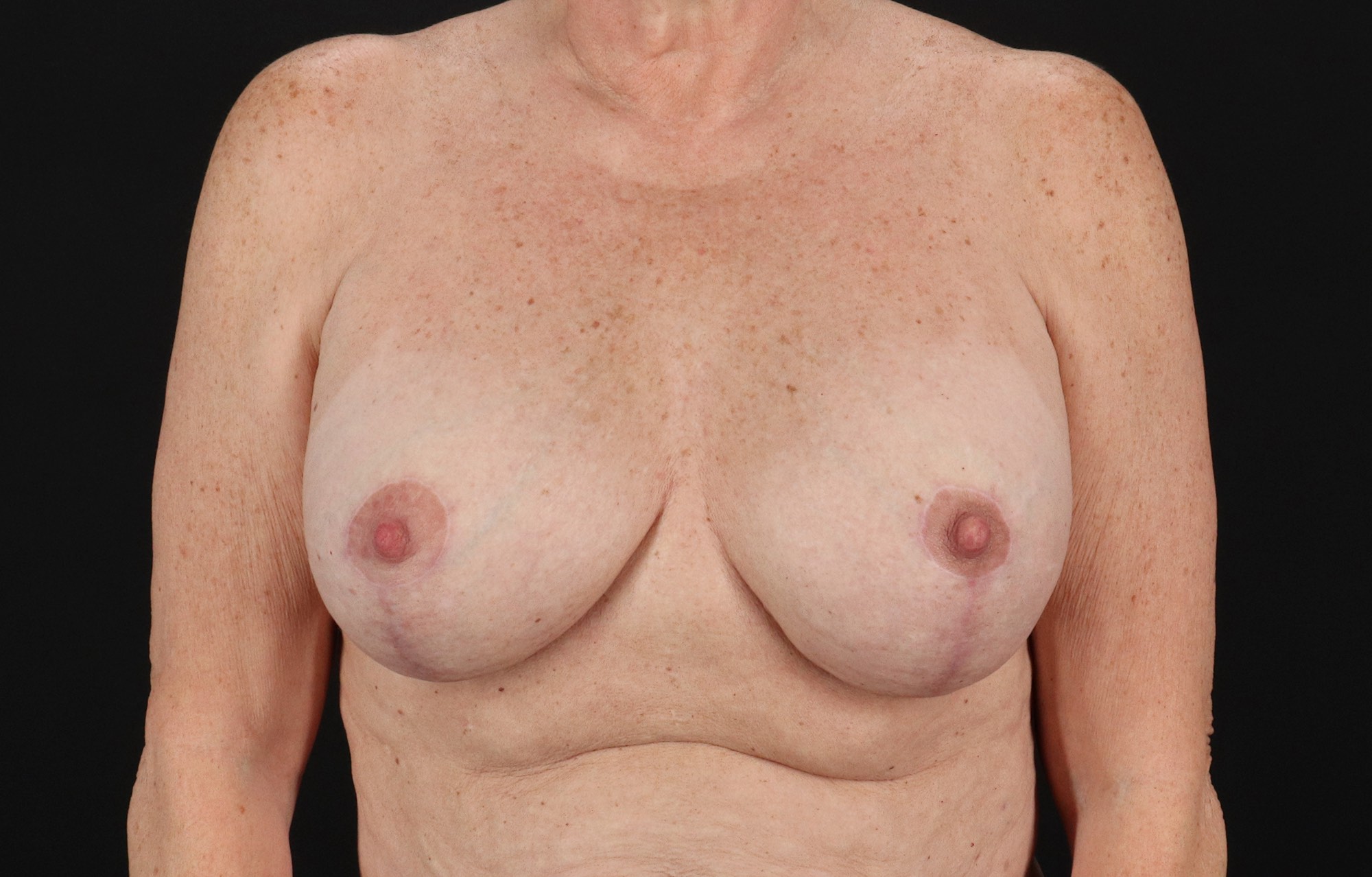 Implant Revision Before & After Patient #3221