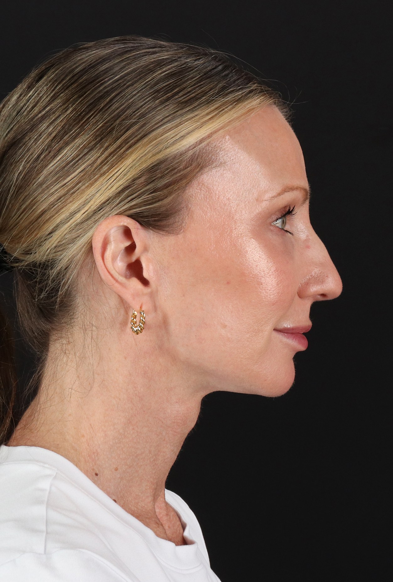 Face Lift Before & After Patient #3219