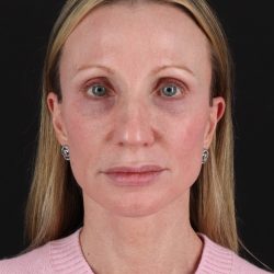 Face Lift Before & After Patient #3219