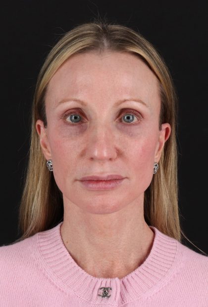 Face Lift Before & After Patient #3219