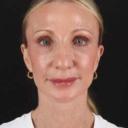 Face Lift Before & After Patient #3219
