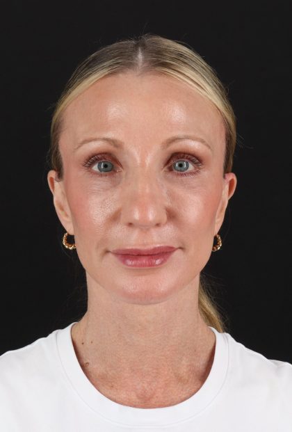 Face Lift Before & After Patient #3219