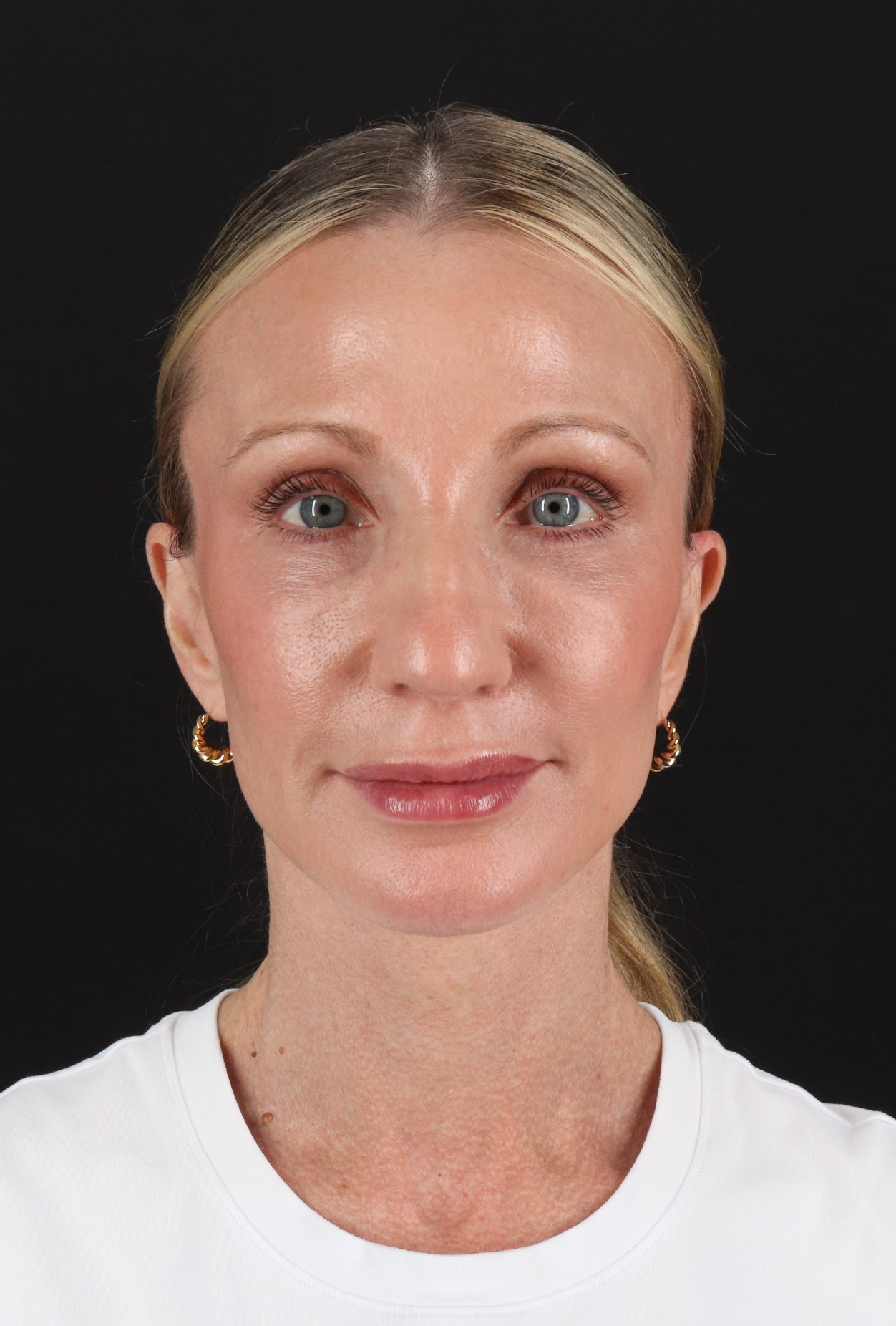 Face Lift Before & After Patient #3219