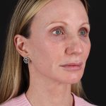 Face Lift Before & After Patient #3219