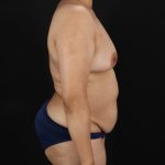 Mommy Makeover Before & After Patient #3226
