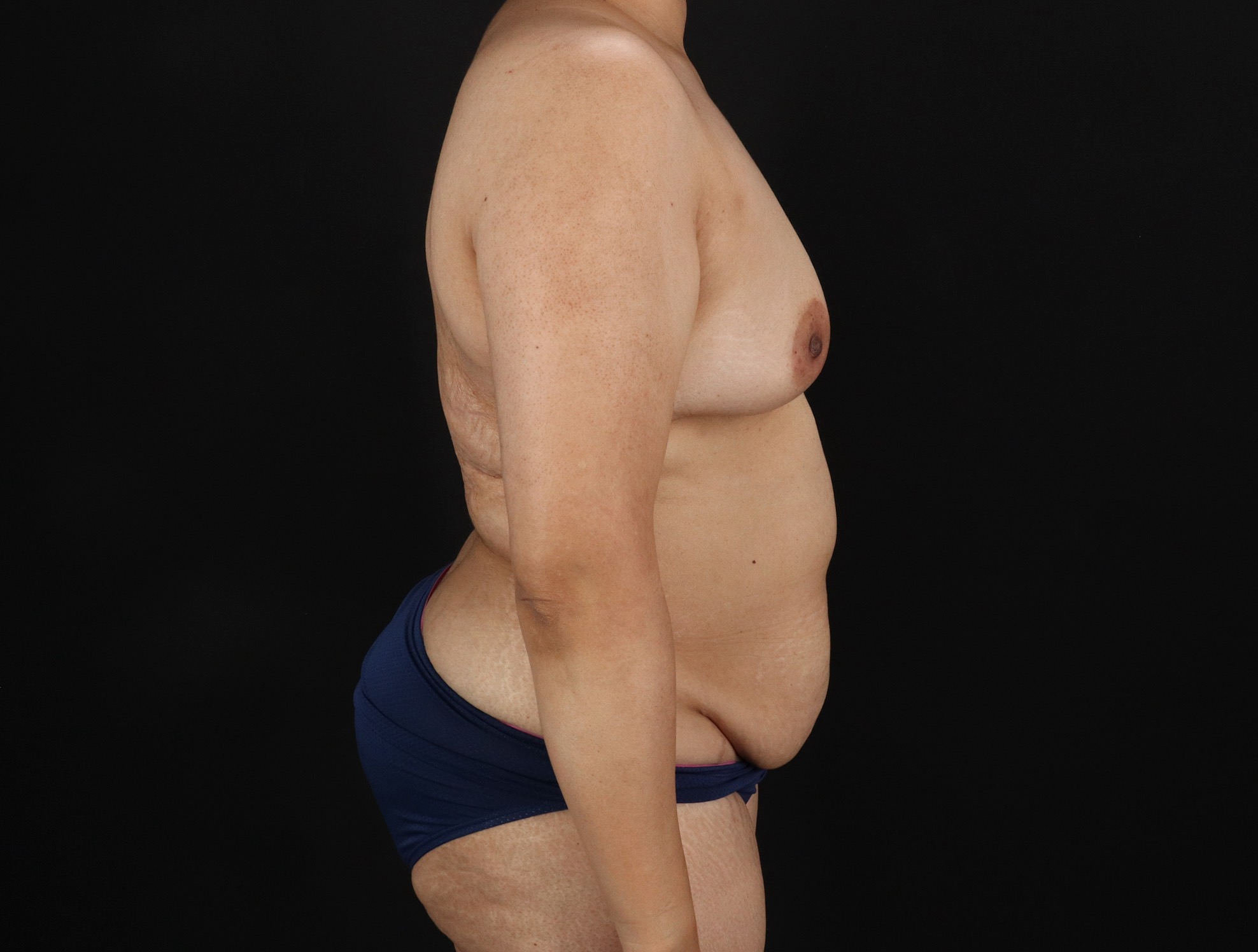 Mommy Makeover Before & After Patient #3226