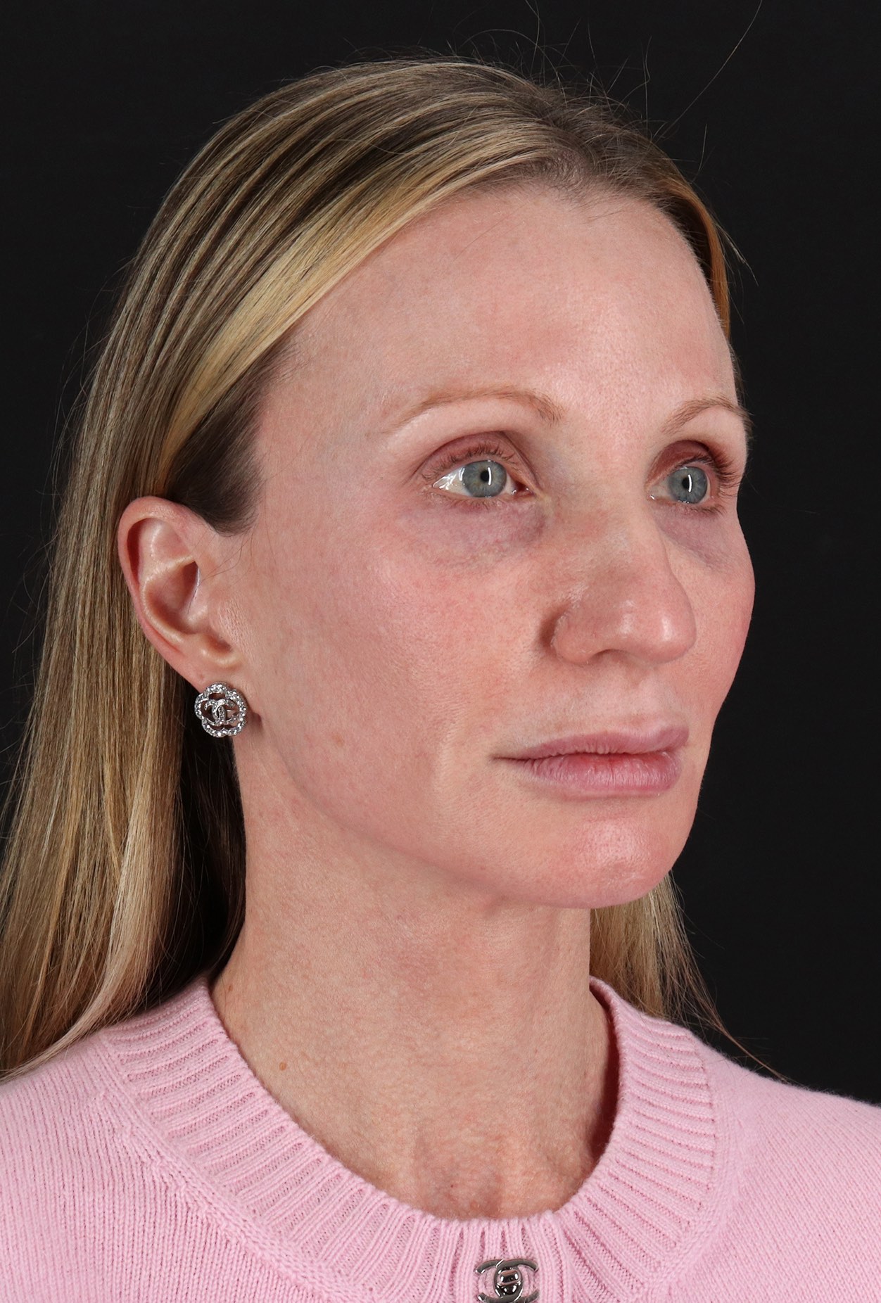 Face Lift Before & After Patient #3219
