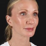 Face Lift Before & After Patient #3219