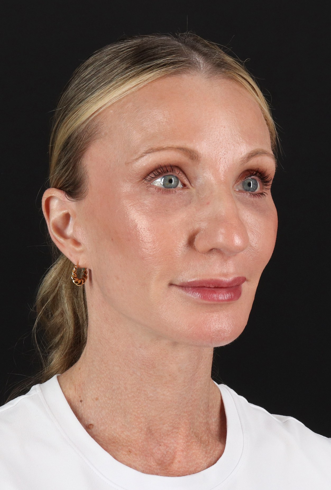 Face Lift Before & After Patient #3219