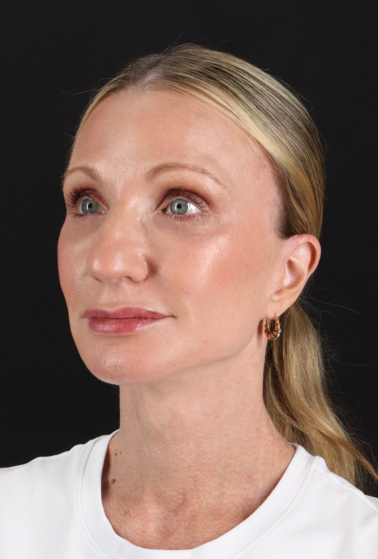 Face Lift Before & After Patient #3219
