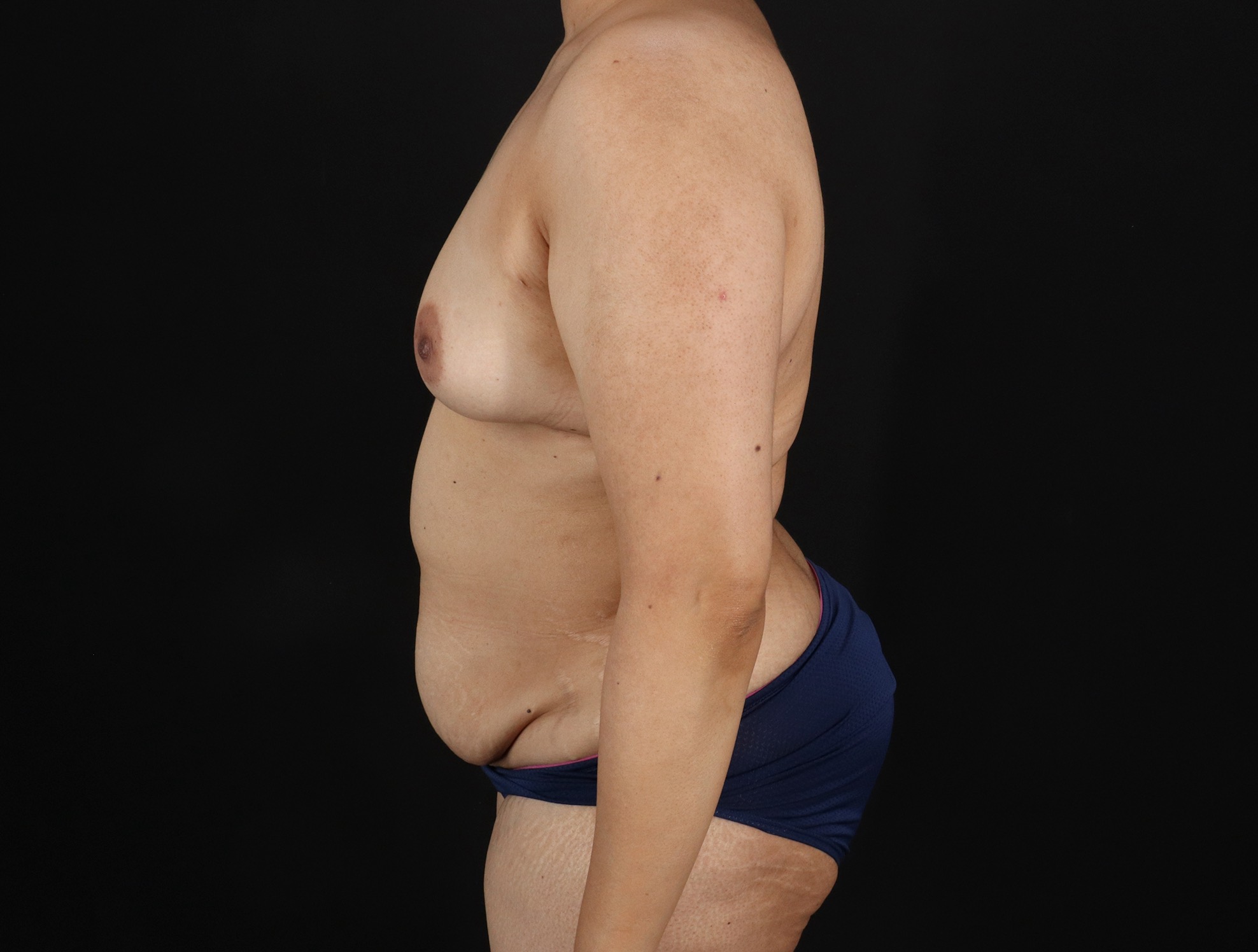 Mommy Makeover Before & After Patient #3226