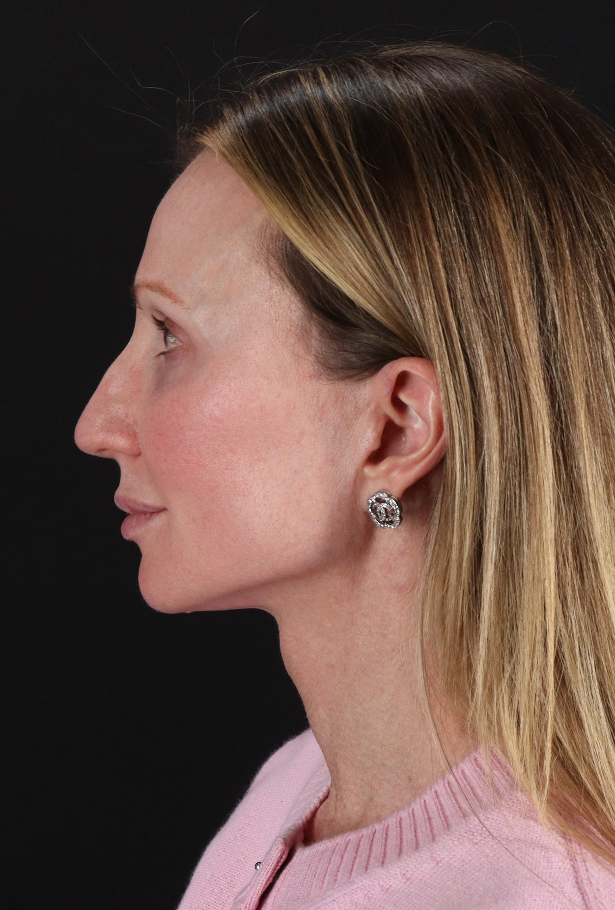 Face Lift Before & After Patient #3219