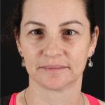 Chemical Peel Before & After Patient #3470
