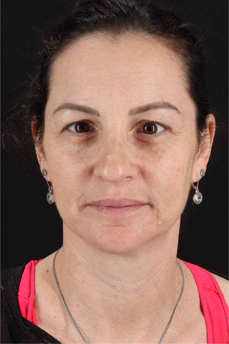 Chemical Peel Before & After Patient #3470