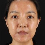 Skin Resurfacing / Laser Before & After Patient #3001