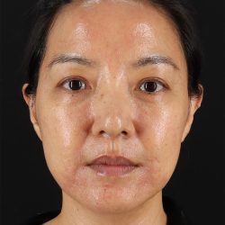 Skin Resurfacing / Laser Before & After Patient #3001