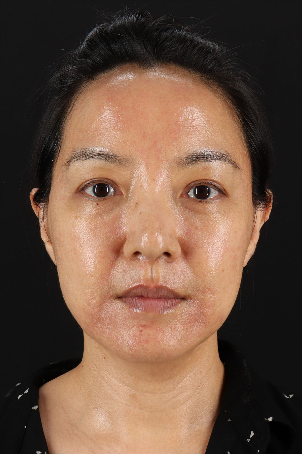 Skin Resurfacing / Laser Before & After Patient #3001