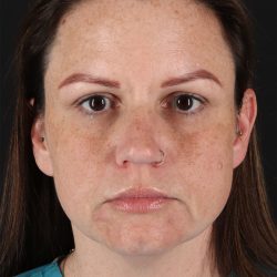 Chemical Peel Before & After Patient #3002