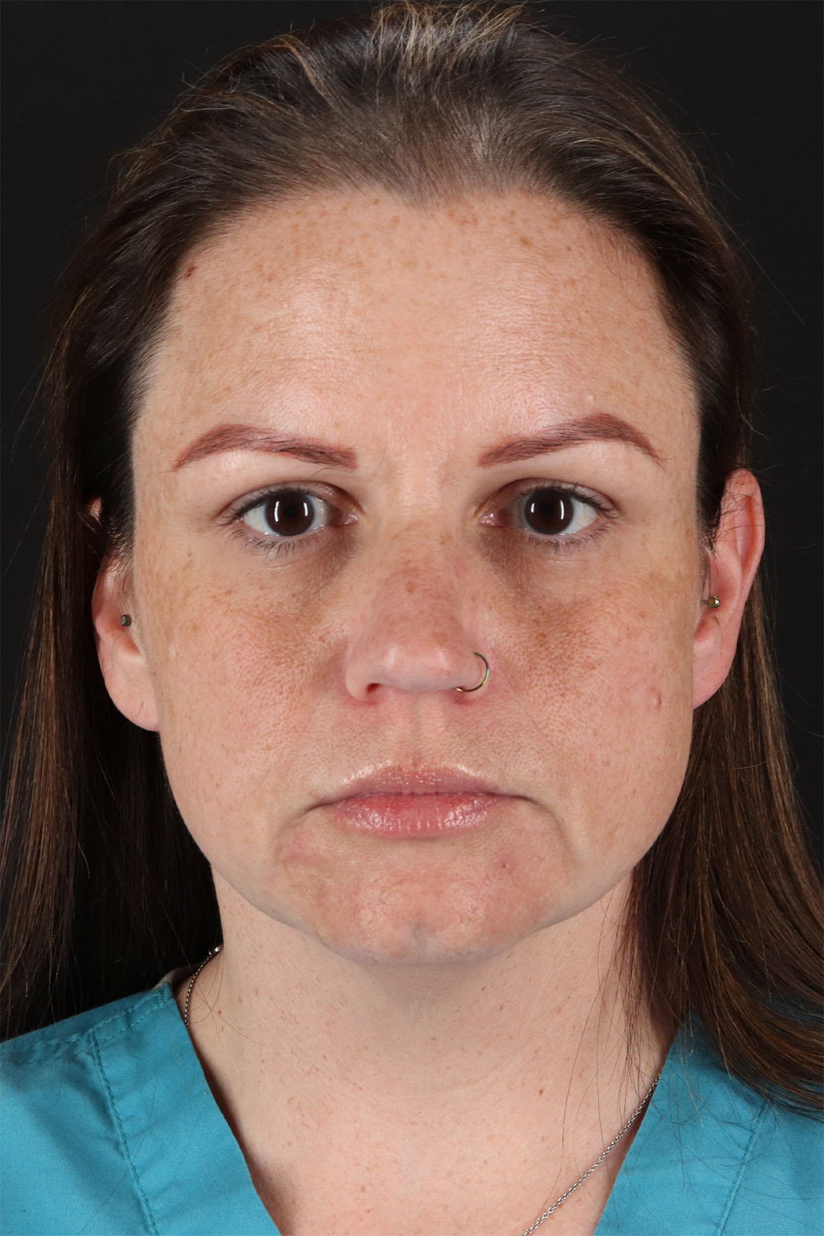 Chemical Peel Before & After Patient #3002