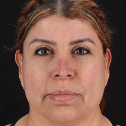 Structural Fat Grafting Before & After Patient #3642