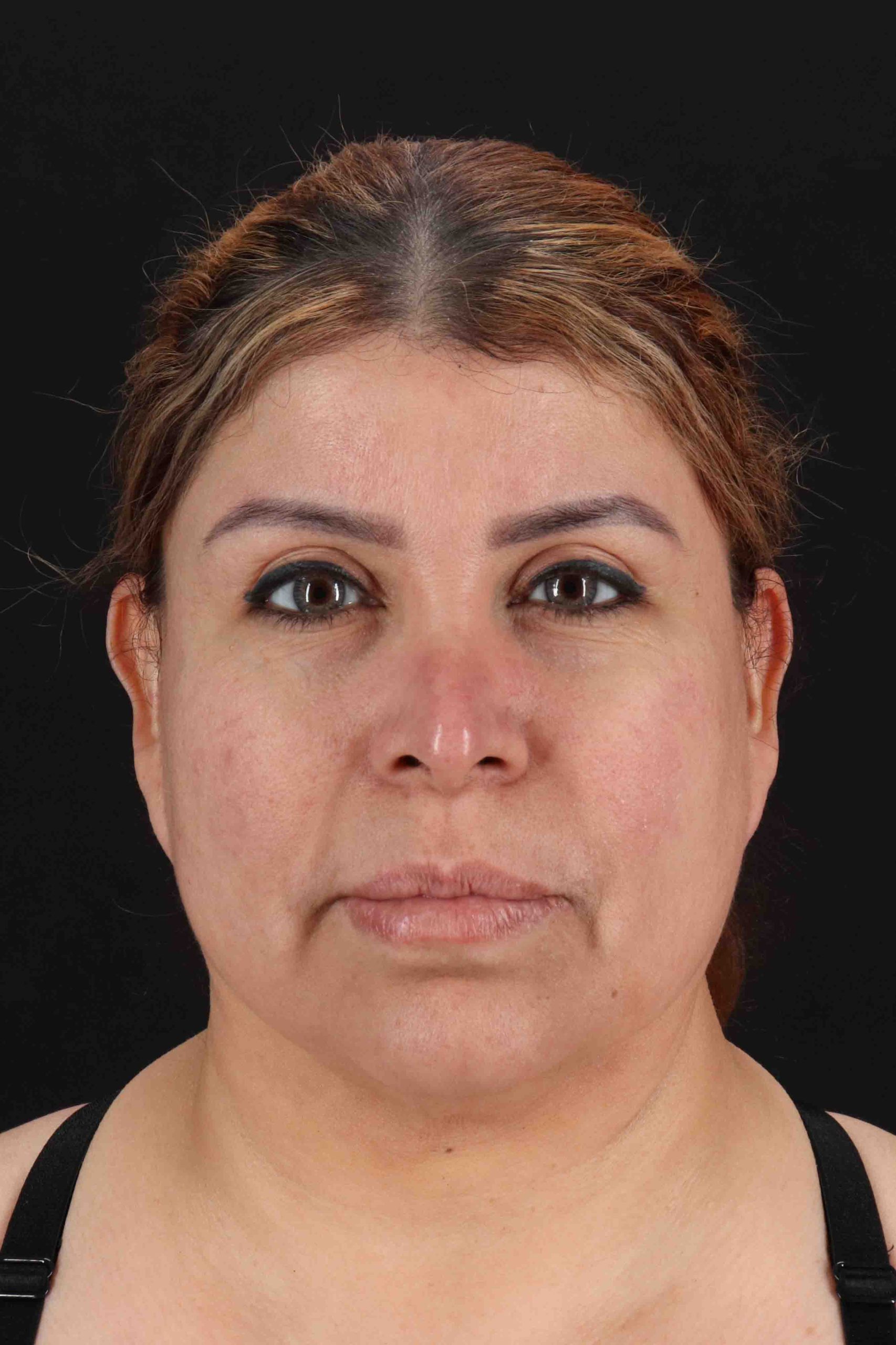 Structural Fat Grafting Before & After Patient #3642
