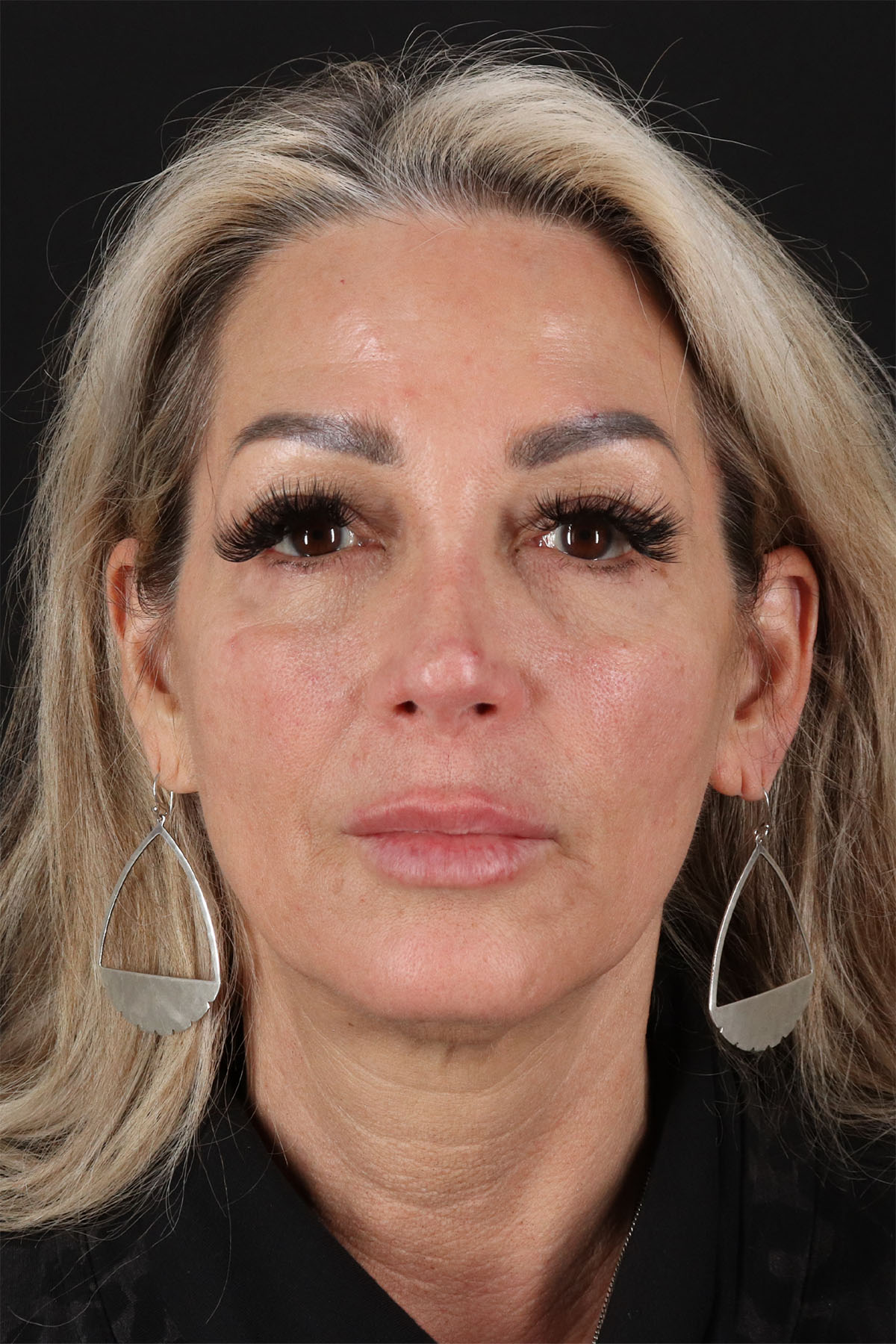 CO2 Laser Before & After Patient #3003