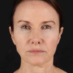 Structural Fat Grafting Before & After Patient #3643