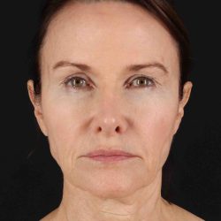 Structural Fat Grafting Before & After Patient #3643