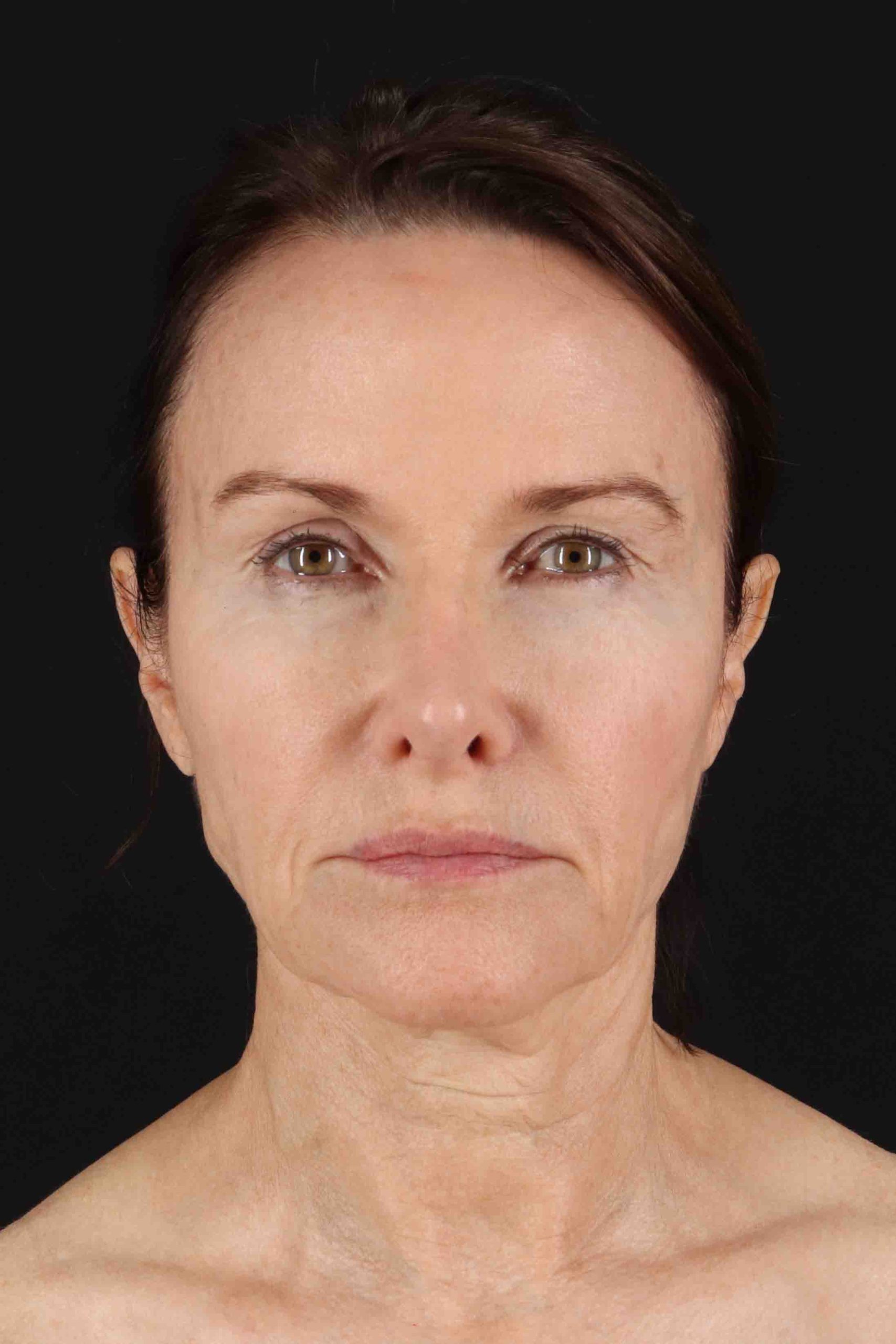 Structural Fat Grafting Before & After Patient #3643