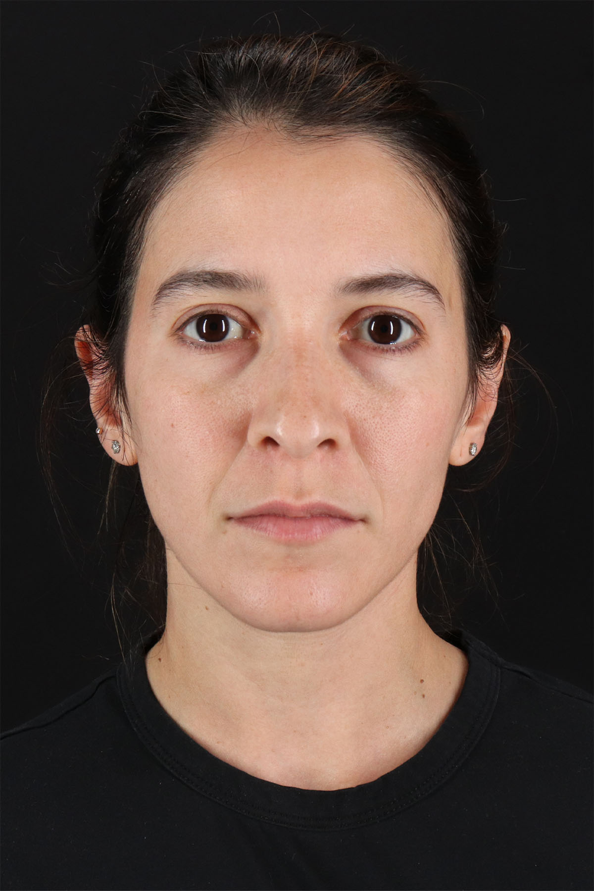 CO2 Laser Before & After Patient #3005