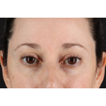 Eyelid Surgery Before & After Patient #3006