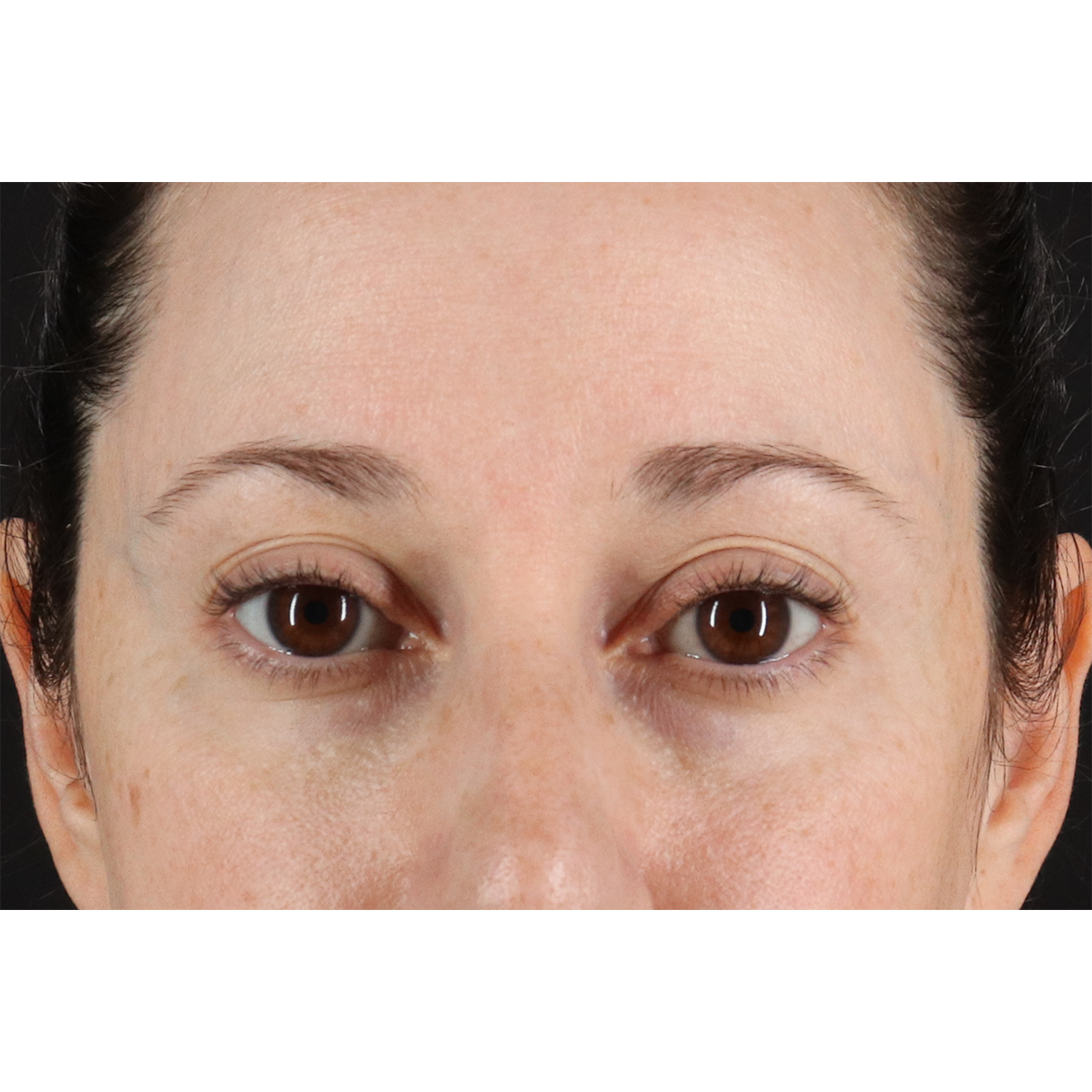 Eyelid Surgery Before & After Patient #3006