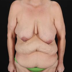 Breast Reduction with Lift Before & After Patient #3007