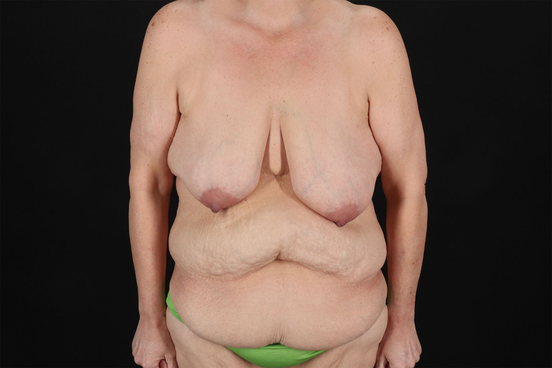Breast Reduction with Lift Before & After Patient #3007