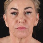 Neck Lift Before & After Patient #3476