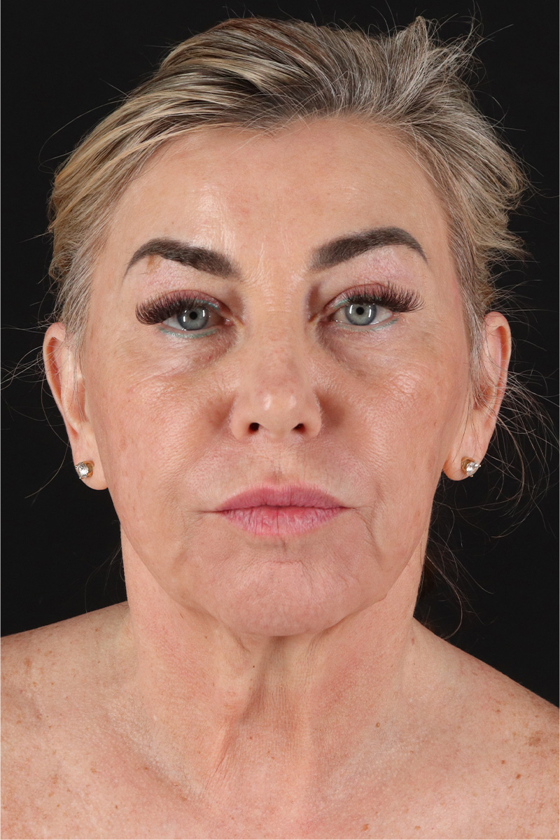 Neck Lift Before & After Patient #3476