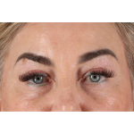 Eyelid Surgery Before & After Patient #3475