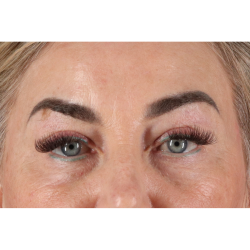 Eyelid Surgery Before & After Patient #3475