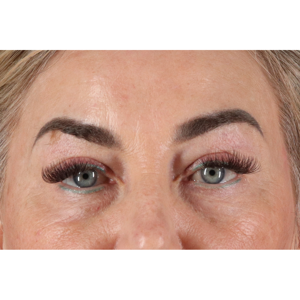 Eyelid Surgery Before & After Patient #3475