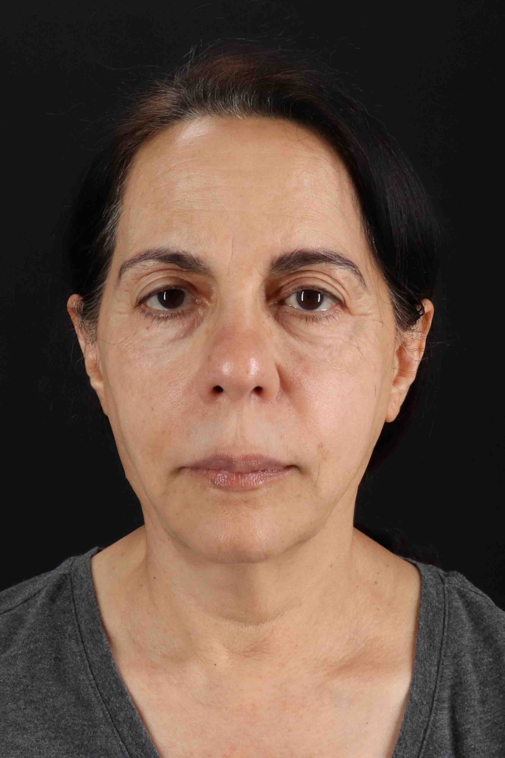 Structural Fat Grafting Before & After Patient #3645