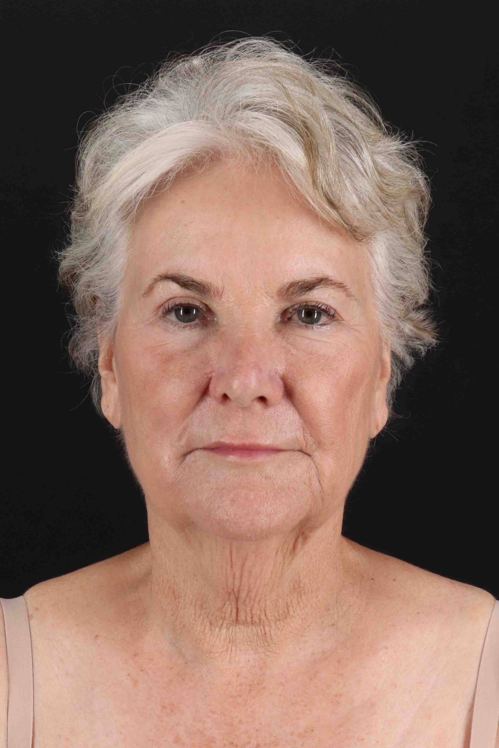 Structural Fat Grafting Before & After Patient #3646