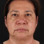 CO2 Laser Before & After Patient #3009