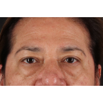 Eyelid Surgery Before & After Patient #3008