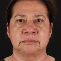 CO2 Laser Before & After Patient #3009