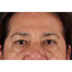 Eyelid Surgery Before & After Patient #3008