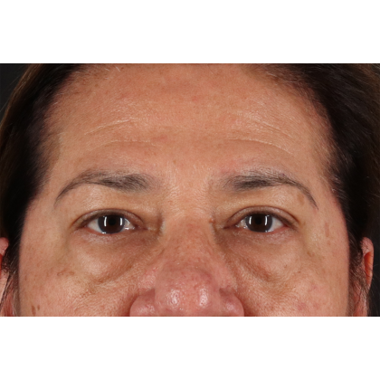 Eyelid Surgery Before & After Patient #3008