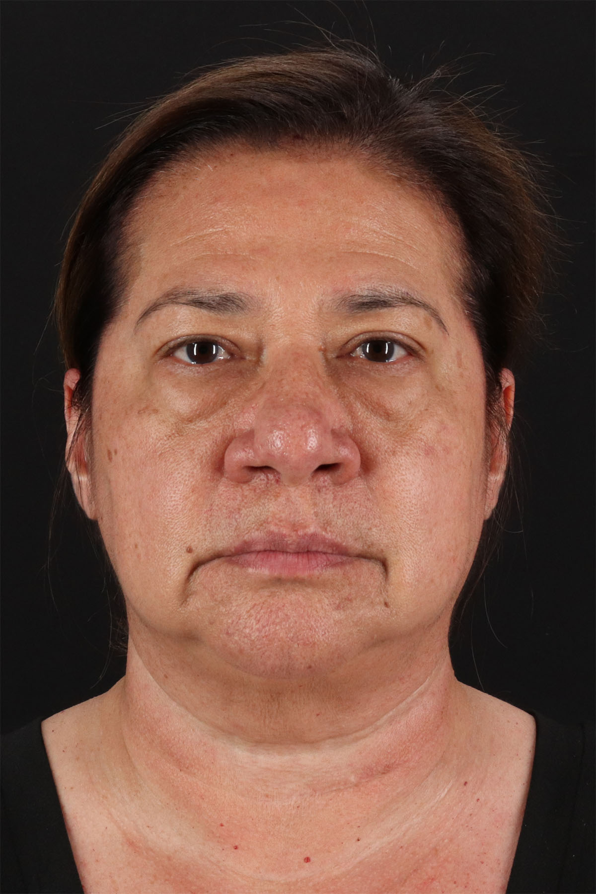 CO2 Laser Before & After Patient #3009