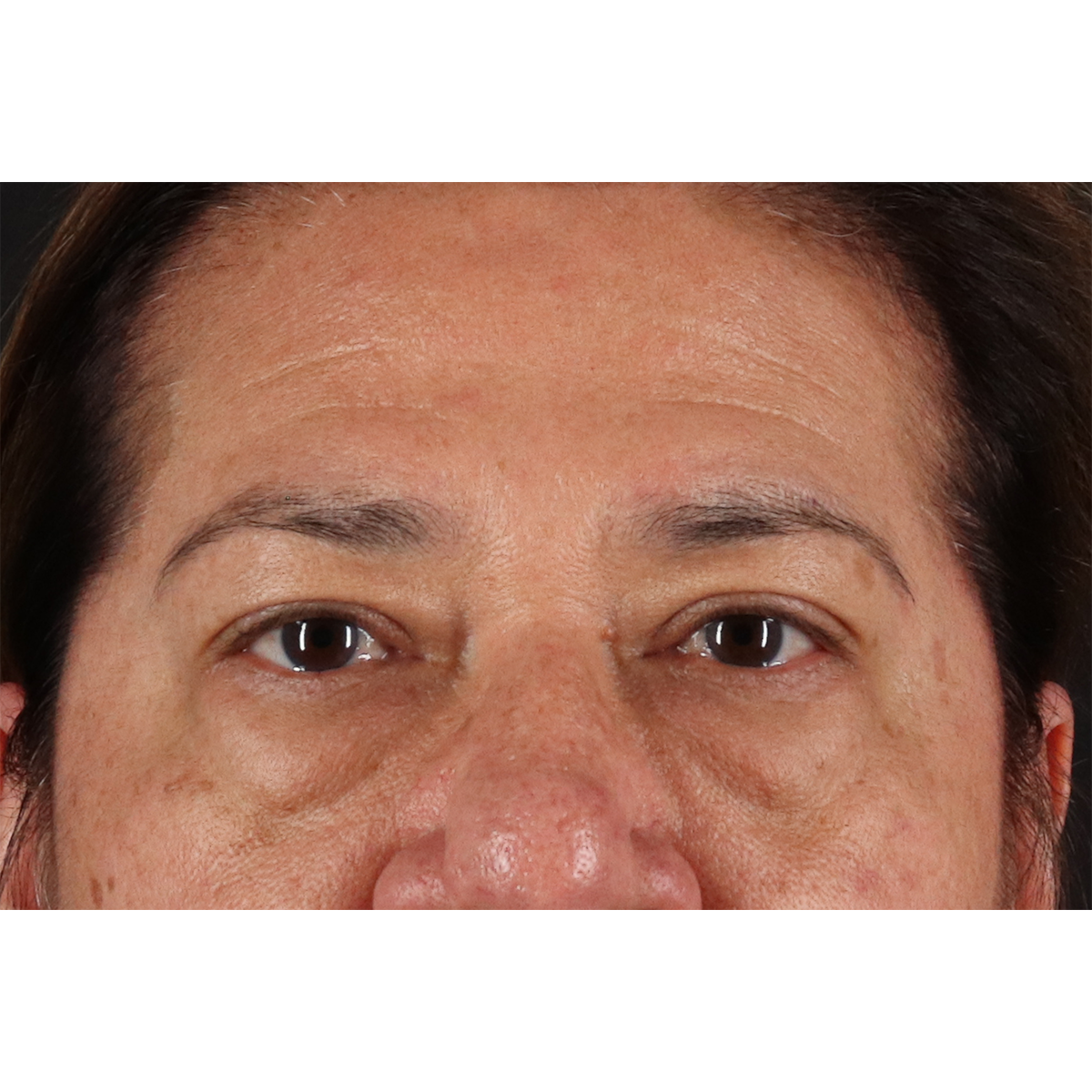 Eyelid Surgery Before & After Patient #3008